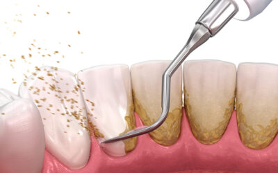 Different Methods Which Are Used To Remove Tartar