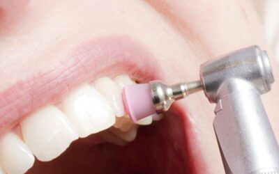 Do scaling and polishing make teeth weak?