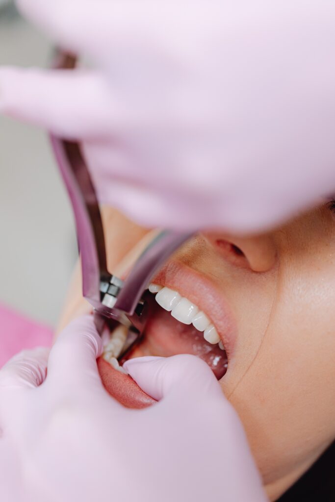 tooth-extraction