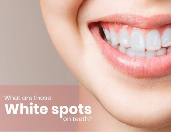 How to get rid of the white spots on your teeth